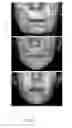 Fig. 03 - METHODS FOR MEASURING CHANGE IN LIP SIZE AFTER AUGMENTATION