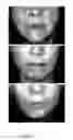 Fig. 04 - METHODS FOR MEASURING CHANGE IN LIP SIZE AFTER AUGMENTATION