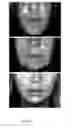 Fig. 05 - METHODS FOR MEASURING CHANGE IN LIP SIZE AFTER AUGMENTATION