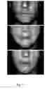 Fig. 08 - METHODS FOR MEASURING CHANGE IN LIP SIZE AFTER AUGMENTATION