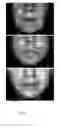 Fig. 09 - METHODS FOR MEASURING CHANGE IN LIP SIZE AFTER AUGMENTATION