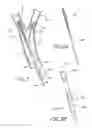 Fig. 04 - Method and apparatus for treating a carotid artery