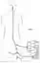 Fig. 02 - DEVICES AND METHODS FOR TREATING VASCULAR MALFORMATIONS