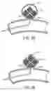 Fig. 22 - DEVICES AND METHODS FOR TREATING VASCULAR MALFORMATIONS