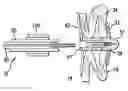 Fig. 01 - Apparatus And Methods For Excluding The Left Atrial Appendage