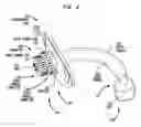 Fig. 03 - TRACHEOSTOMY TUBE HAVING A CUFFED INNER CANNULA