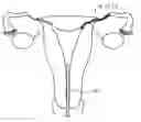 Fig. 01 - Method and apparatus for endometrial ablation in combination with intrafallopian contraceptive devices