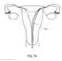 Fig. 04 - Method and apparatus for endometrial ablation in combination with intrafallopian contraceptive devices