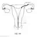 Fig. 09 - Method and apparatus for endometrial ablation in combination with intrafallopian contraceptive devices
