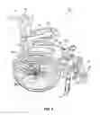 Fig. 06 - Delordosation device