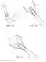 Fig. 02 - Method and device for uterine fibroid treatment