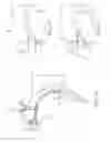 Fig. 03 - Method and device for uterine fibroid treatment