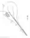 Fig. 08 - Method and device for uterine fibroid treatment