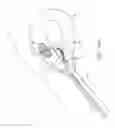 Fig. 23 - Method and device for uterine fibroid treatment