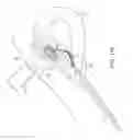 Fig. 24 - Method and device for uterine fibroid treatment