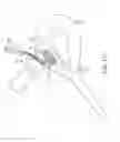 Fig. 25 - Method and device for uterine fibroid treatment