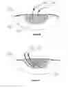 Fig. 22 - APPARATUS FOR ASPIRATING, IRRIGATING AND CLEANSING WOUNDS