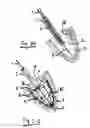 Fig. 03 - System for improving diastolic dysfunction