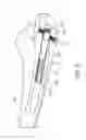 Fig. 10 - Bone fixation device, tools and methods