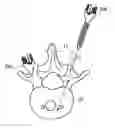 Fig. 01 - METHOD FOR GUIDING SYMMETRIC IMPLANTATION OF BONE SCREWS