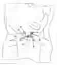 Fig. 01 - Device for Hygienic Extraction of an Acne Related Impaction
