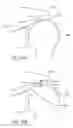 Fig. 43 - METHODS AND DEVICES FOR CONTINUOUS SUTURE PASSING