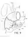 Fig. 08 - BILIARY DECOMPRESSION AND ANASTOMOSIS STENT