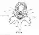 Fig. 04 - Minimally invasive discectomy