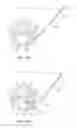 Fig. 33 - Minimally invasive discectomy