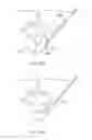Fig. 35 - Minimally invasive discectomy