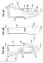 Fig. 09 - Absorbable bone anchor