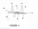Fig. 05 - Spinous process fixation plate and minimally invasive method for placement