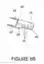 Fig. 07 - Spinous process fixation plate and minimally invasive method for placement