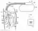 Fig. 01 - IMPLANTABLE DEVICE WITH HEMODYNAMIC SUPPORT OR RESUSCITATION THERAPY