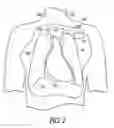 Fig. 03 - IMPLANTABLE DEVICE WITH HEMODYNAMIC SUPPORT OR RESUSCITATION THERAPY