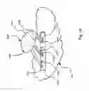 Fig. 22 - Implantable Interface for a Medical Device System