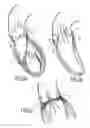 Fig. 02 - Method of treating aortic stenosis using an implantable prosthetic valve