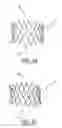 Fig. 04 - Method of treating aortic stenosis using an implantable prosthetic valve