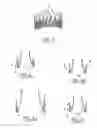 Fig. 07 - Method of treating aortic stenosis using an implantable prosthetic valve