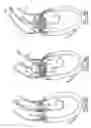 Fig. 19 - Method of treating aortic stenosis using an implantable prosthetic valve