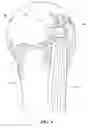 Fig. 05 - METHOD & APPARATUS FOR ARTHROSCOPIC BICEPS TENODESIS