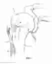 Fig. 06 - METHOD & APPARATUS FOR ARTHROSCOPIC BICEPS TENODESIS