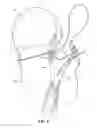 Fig. 07 - METHOD & APPARATUS FOR ARTHROSCOPIC BICEPS TENODESIS