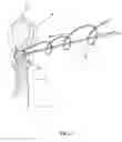 Fig. 08 - METHOD & APPARATUS FOR ARTHROSCOPIC BICEPS TENODESIS