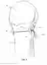 Fig. 09 - METHOD & APPARATUS FOR ARTHROSCOPIC BICEPS TENODESIS