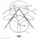 Fig. 08 - ARTICULATING DISC IMPLANT