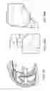 Fig. 136 - Patient-adapted and improved articular implants, designs and related guide tools