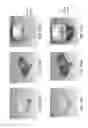 Fig. 197 - Patient-adapted and improved articular implants, designs and related guide tools