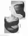 Fig. 40 - Patient-adapted and improved articular implants, designs and related guide tools
