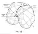Fig. 49 - Patient-adapted and improved articular implants, designs and related guide tools